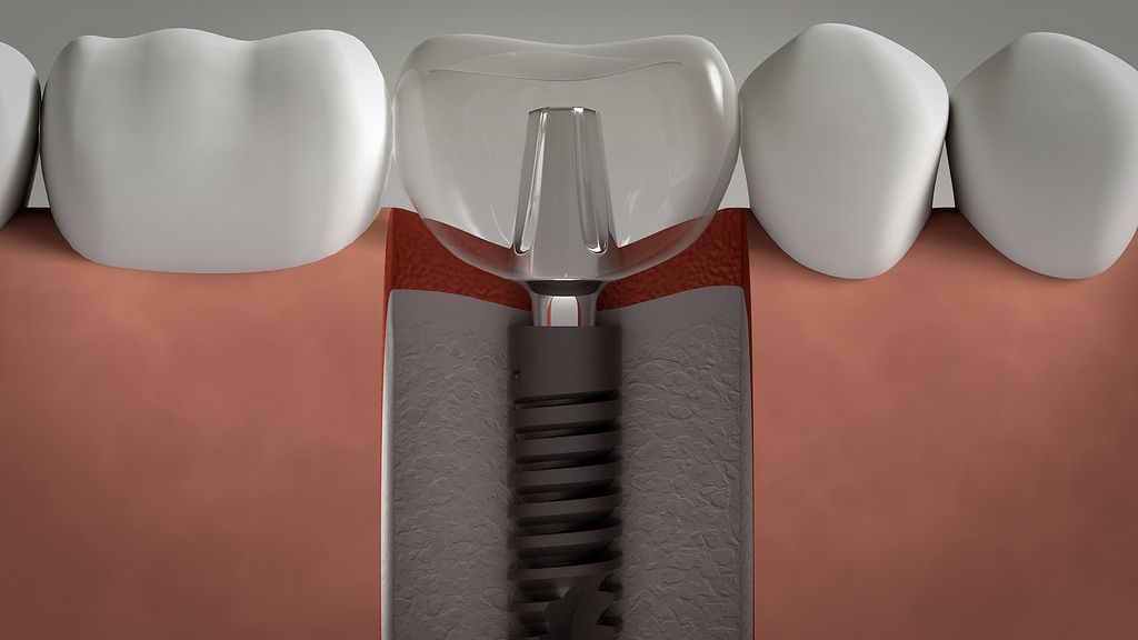 Cắm Implant Khi Mất Một Răng & Quy trình Cấy Ghép 1 Răng Implant