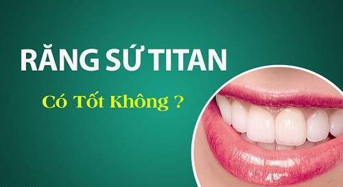 Răng Sứ Titan Có Tốt Không & Những Điều Cần Biết Khi Bọc Răng Sứ Titan