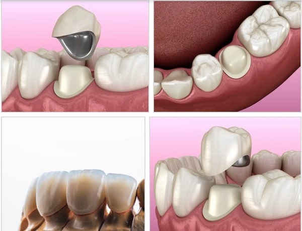 Răng Sứ Titan Có Tốt Không & Bọc Răng Sứ Giá Rẻ Tại TpHCM
