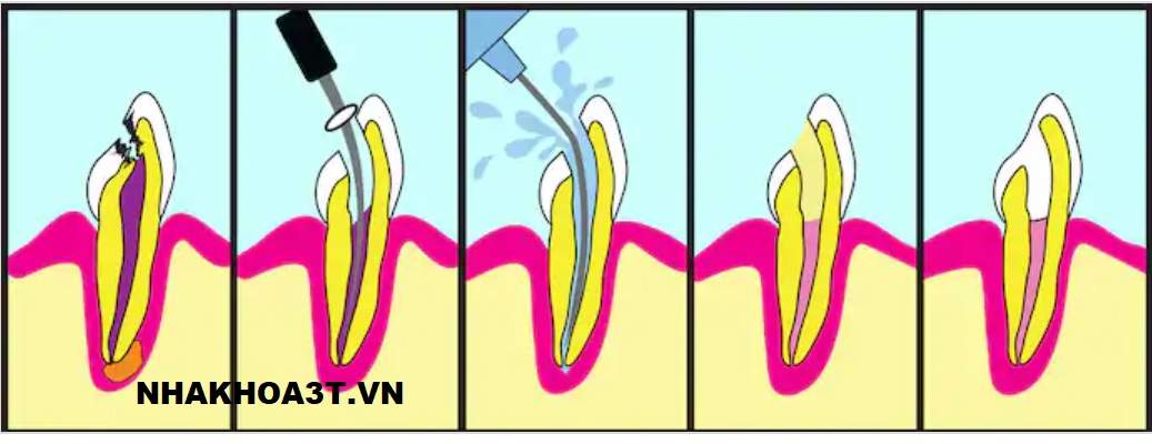 Lấy tủy răng uy tín & không đau tại Tp.HCM