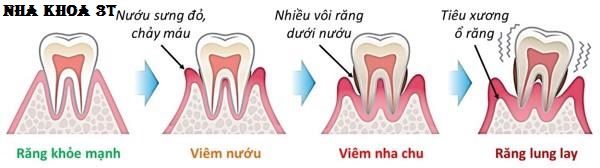 Bạn có biết tác hại của vôi răng?