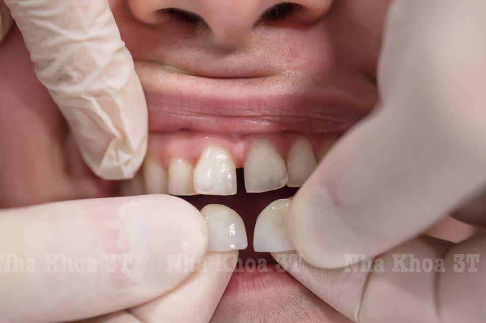 răng sứ bị lỏng