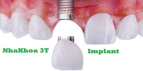 Mất răng cửa - Giải pháp điều trị tối ưu nhất hiện nay là gì?