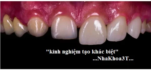 Răng Thưa Có Bọc Răng Sứ Được Không & Bọc Răng Sứ Giá Rẻ Tại TpHCM