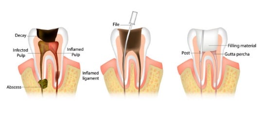 Có Bầu Lấy Tủy Răng Đươc Không & Mang Thai Cần Lưu Ý Gì Khi Làm Răng