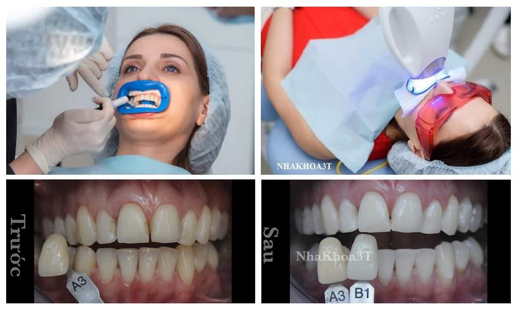 Giá tẩy trắng răng 2021 & Tẩy trắng răng giá mới nhất 2021