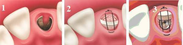 Phương Pháp Phục Hình Implant Tức Thì Ngay Sau Khi Nhổ Răng Là Gì?
