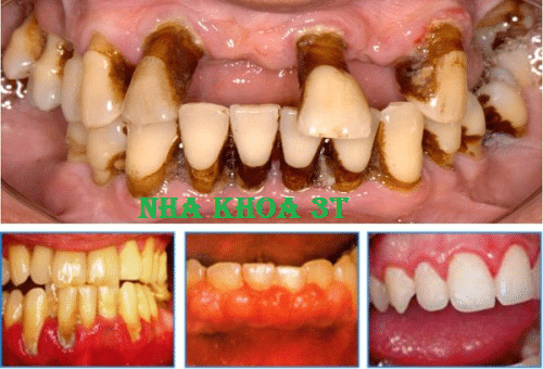 Các bệnh về răng & Các bệnh về miệng