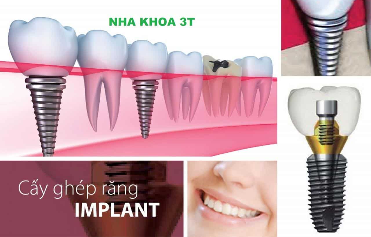 Trồng Implant 