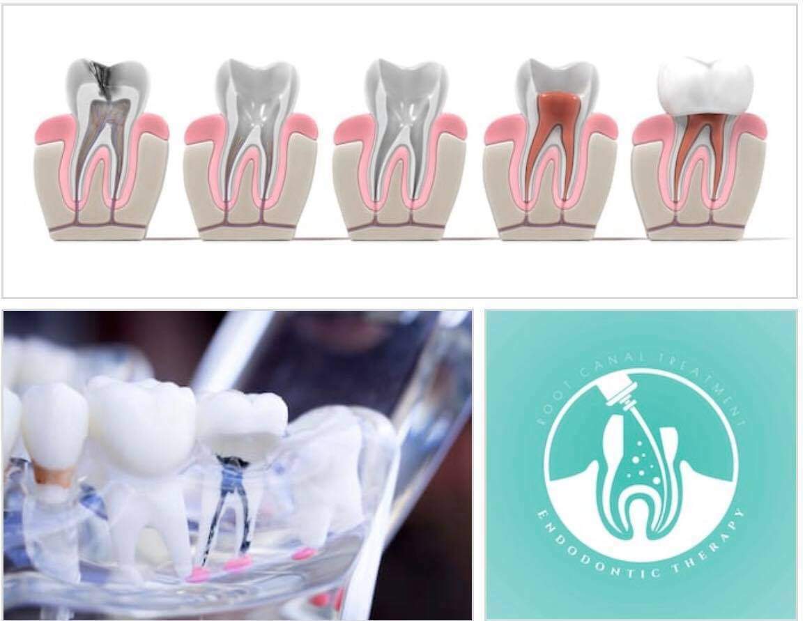 Sau Khi Lấy Tủy Răng Có Lỗ Sâu To Nên Bọc Răng Sứ Hay Trám Răng?
