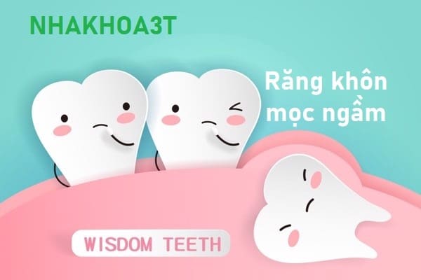 Răng khôn mọc ngầm