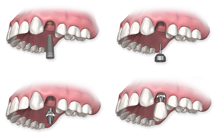 Phương Pháp Phục Hình Implant Tức Thì Ngay Sau Khi Nhổ Răng Là Gì?