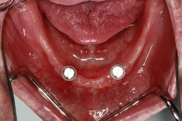 Mất răng toàn hàm thì cấy mấy trụ Implant & trồng implant giá rẻ TpHCM