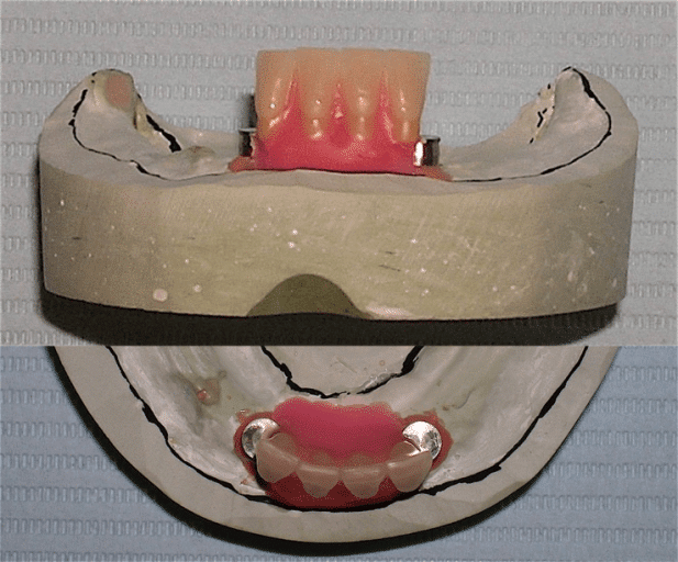 Mất răng toàn hàm thì cấy mấy trụ Implant & trồng implant giá rẻ TpHCM