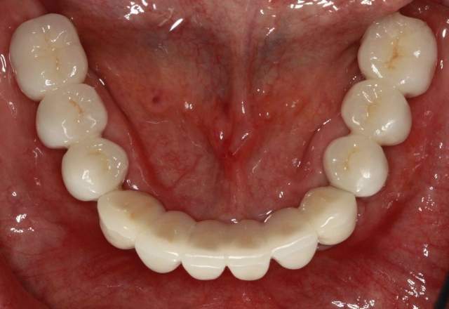 Cấy Ghép Implant Cho Trường Hợp Mất Nhiều Răng Có Được Không?