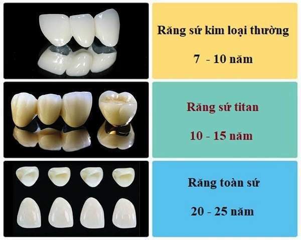 Răng Sứ Titan Có Tốt Không & Những Điều Cần Biết Khi Bọc Răng Sứ Titan