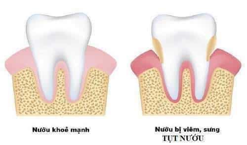 Vôi răng là nguyên nhân gây tụt nướu
