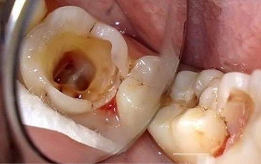 Quy Trình, Bảng Giá Nhổ Răng & Những Trường Hợp Cần Phải Nhổ Răng