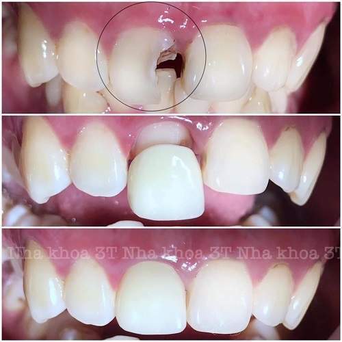 Hình Ảnh Trước Và Sau Khi Bọc Răng Sứ Cho Răng Mẻ
