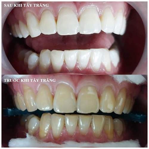 Hình Ảnh Trước và Sau Khi Tẩy Trắng Răng