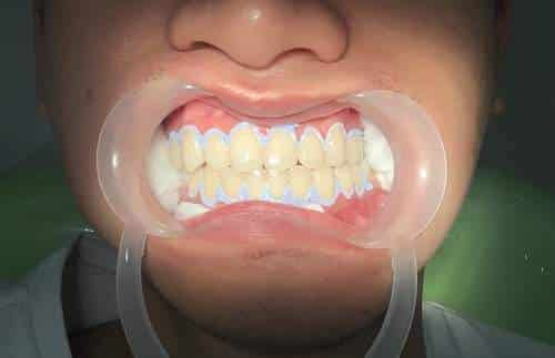 tẩy trắng răng,tẩy trắng răng có an toàn không,tẩy trắng răng có đau không,tẩy trắng răng có ê buốt không,giá tẩy trắng răng