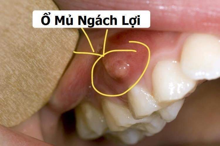 Viêm tủy răng có mủ là gì?