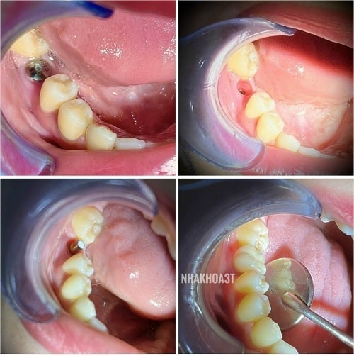 Mất Một Răng Nên Trồng Răng Giả Bằng Cầu Răng Sứ Hay Cấy Ghép Implant?