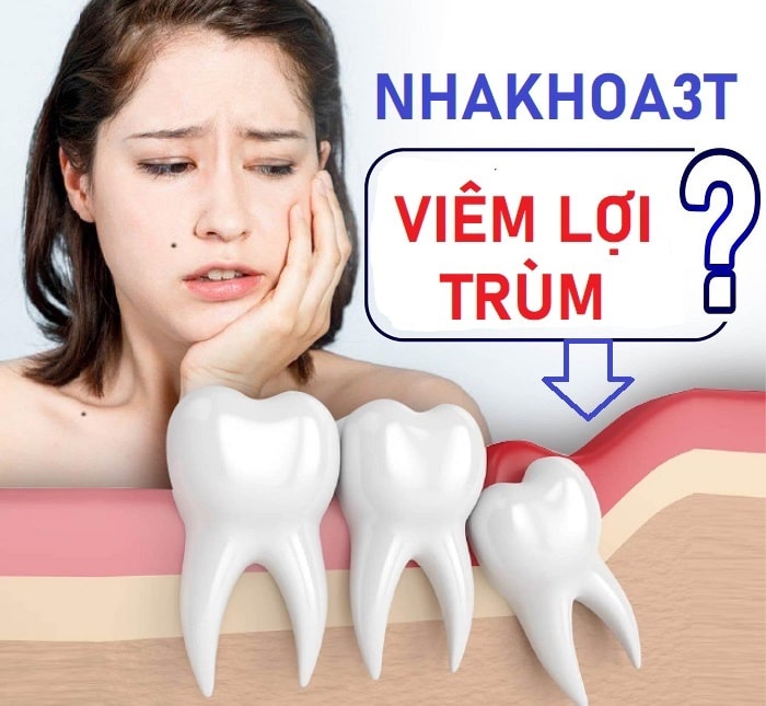 viêm lợi trùm gây đau răng khôn