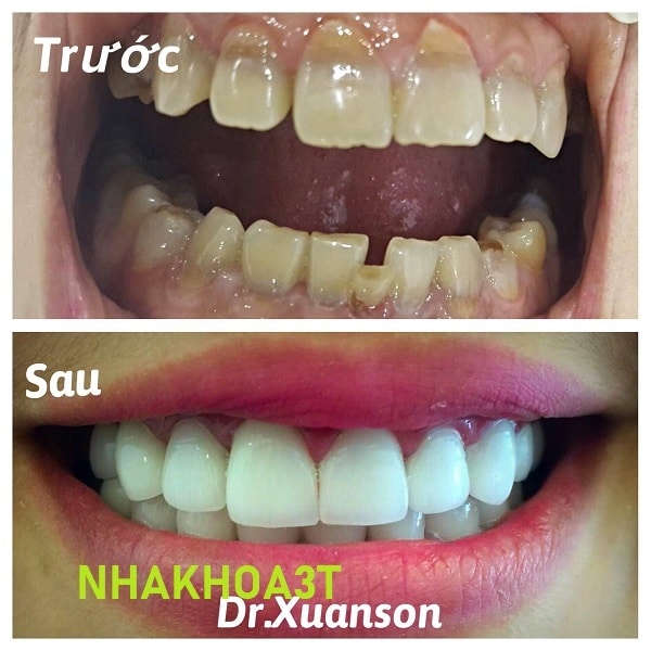 Nên Tẩy Trắng Răng Hay Bọc Răng Sứ Thẩm Mỹ Cho Răng Nhiễm Tetracycline