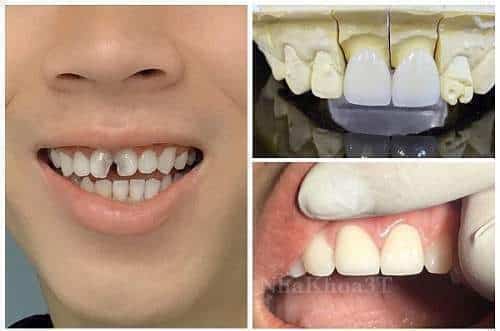 Mẻ Răng Cửa Phải Làm Sao & Răng Bị Mẻ Có Sao Không?