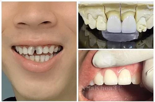 Mẻ Răng Cửa Phải Làm Sao & Răng Bị Mẻ Có Sao Không?