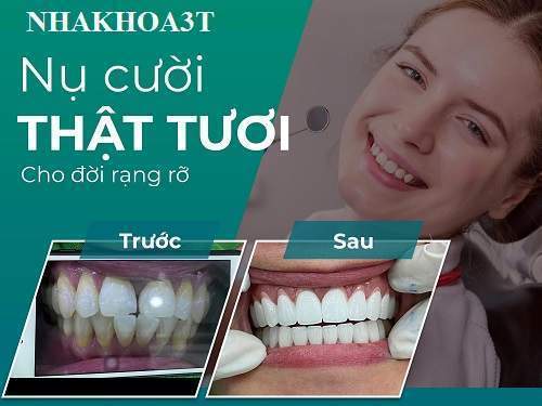 Dán Sứ Là Gì & Bạn Có Biết Về Công Nghệ Bọc Răng Sứ Không Mài Nhỏ Răng?