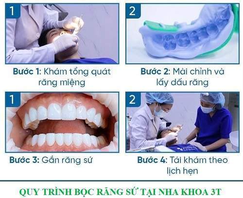 quy trình bọc sứ 4 răng cửa