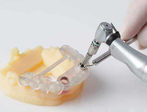 Cấy Ghép Implant Bằng Máng Hướng Dẫn Phẫu Thuật In 3D Hiện Đại