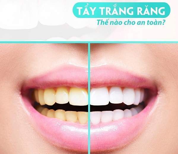 Hình Ảnh Trước và Sau Khi Tẩy Trắng Răng