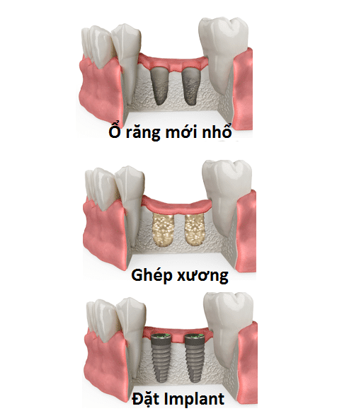 ghép xương ở răng