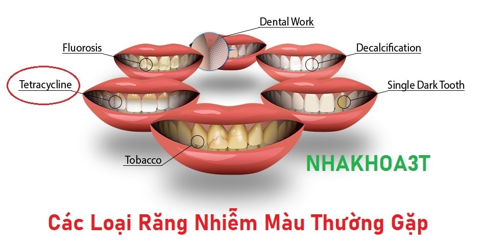 Nên Tẩy Trắng Răng Hay Bọc Răng Sứ Thẩm Mỹ Cho Răng Nhiễm Tetracycline