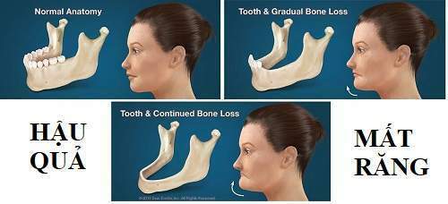 Hậu Quả Khi Mất Răng & Những Lợi Ích Của Việc Trồng Implant Mang Lại