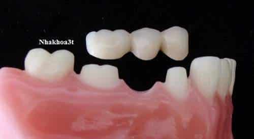 6 Hậu Quả Khi Mất Răng & Phương Pháp Bắc Cầu Răng Sứ Là Gì?