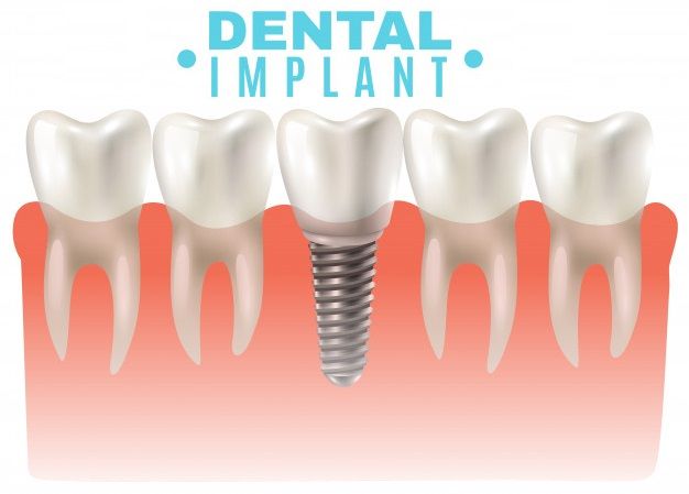Độ Bền Của Trồng Răng Implant?