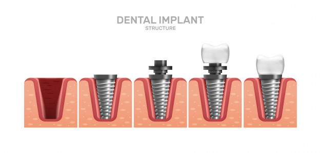 Chăm sóc răng miệng sau khi cấy ghép Implant đúng cách?