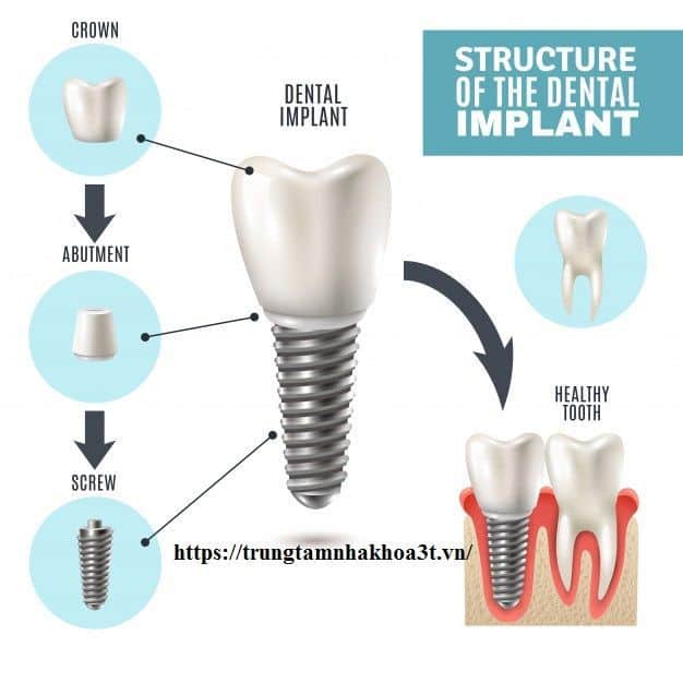 Độ Bền Của Trồng Răng Implant?