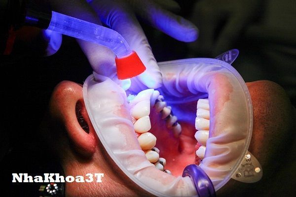 Tuổi thọ của răng bị trám? Trám răng có bền không?