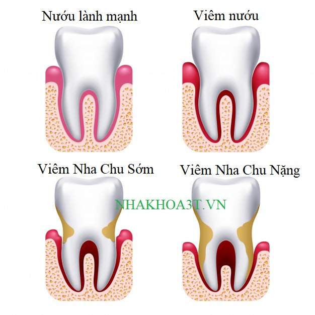 human gum disease gums bleeding tooth disease prevention dental oral care 53562 2529 1