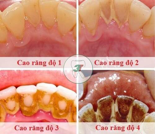 phân loại mức độ vôi răng