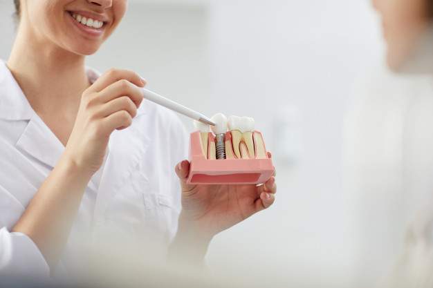 Chăm sóc răng miệng sau khi cấy ghép Implant đúng cách?