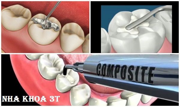 cách phòng ngừa răng sâu,các bước trám răng,bảng giá trám răng sâu,bọc răng sứ giá rẻ,bọc răng sứ đẹp