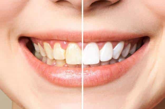 ?giá tẩy trắng răng,tẩy trắng răng giá bao nhiêu,tẩy trắng răng tại nhà,tẩy trắng răng tại phòng khám,tẩy trắng răng laser,bảo hiểm y tế