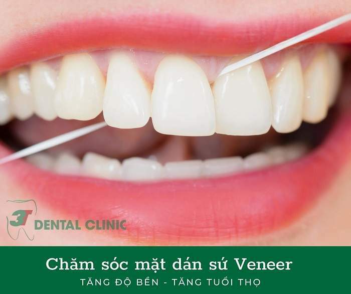 chăm sóc răng sau khi dán Veneer