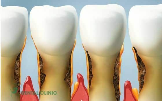 Răng bị tụt nướu và răng bị dài ra